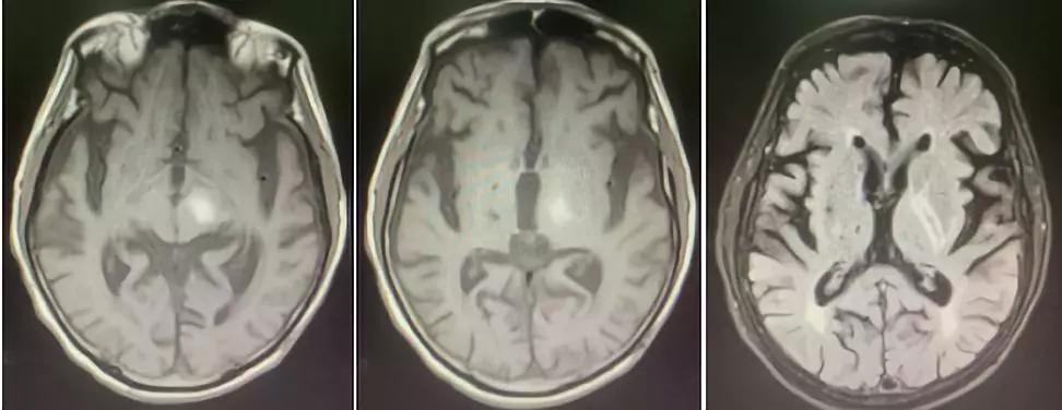 当纹状体黑质神经细胞受到创伤后,使得γ-氨基丁酸减少,而接受多巴胺