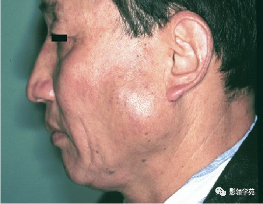 肿大淋巴结边界常不清楚.