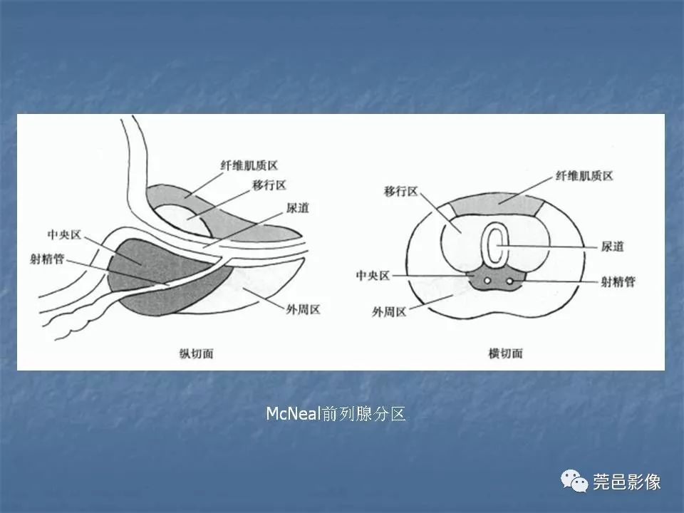 肉芽肿性前列腺炎mri表现与鉴别