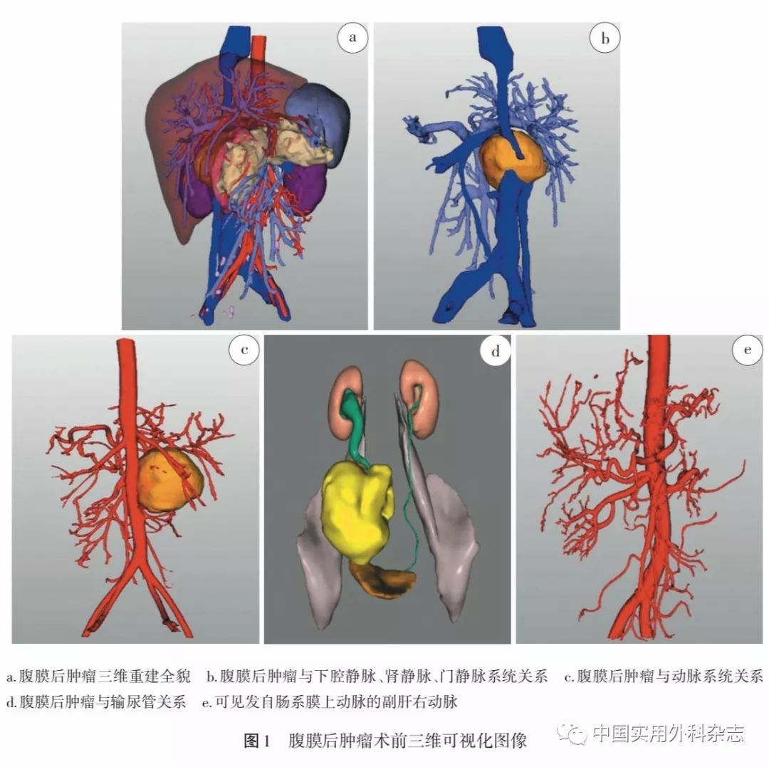 論著三維可視化技術在腹膜後腫瘤切除術中應用研究