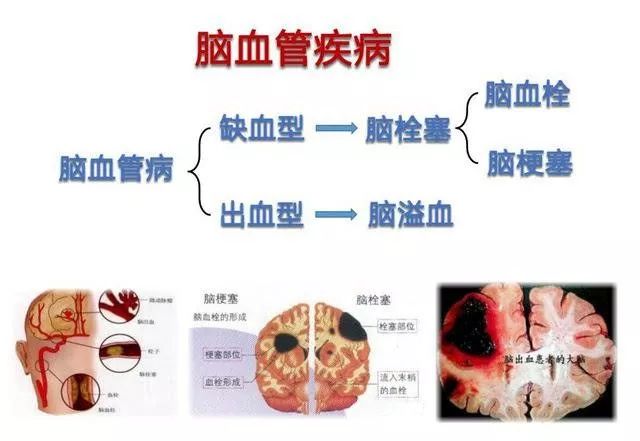 常见的几款心脑血管疾病