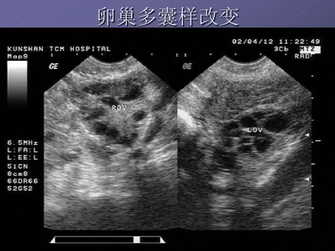 阴超 多囊卵巢图片