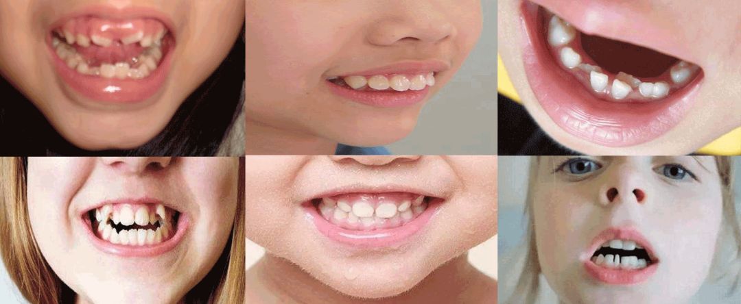 牙齿不齐,地包天,天包地等口腔情况会导致孩子长相发生变化,这