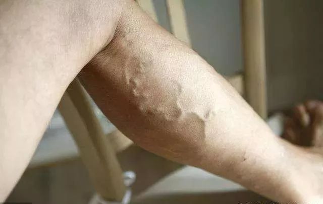腿上青筋暴起在生姜里加了点它在腿上一刮青筋消失从此不再胀痛