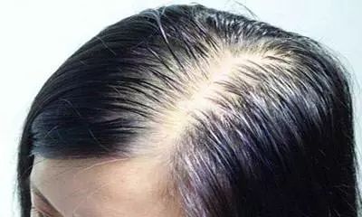 产后脱发