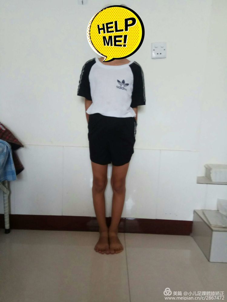 x型腿和o型腿是一种正好相反的腿部畸形河南安阳肢体矫形门诊专业矫正