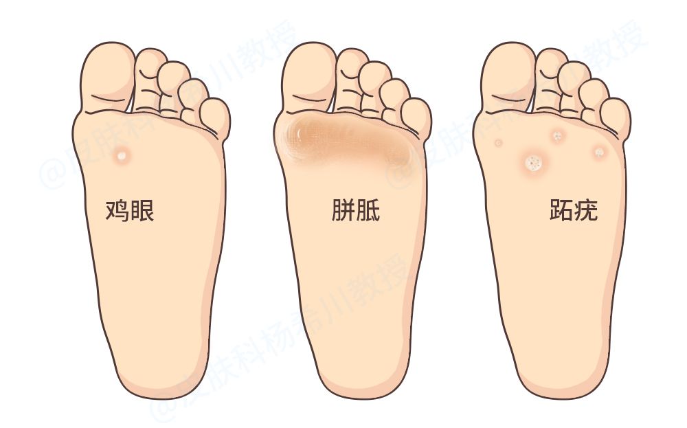 鸡眼跖疣傻傻分不清楚可不行