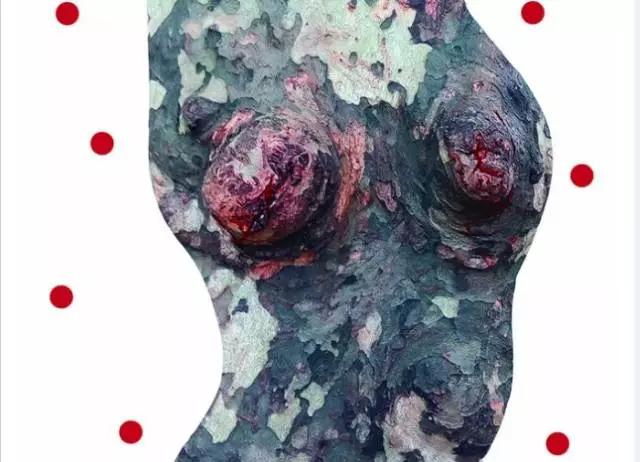 肉芽肿性乳腺炎:可能比乳腺癌更可怕_病人