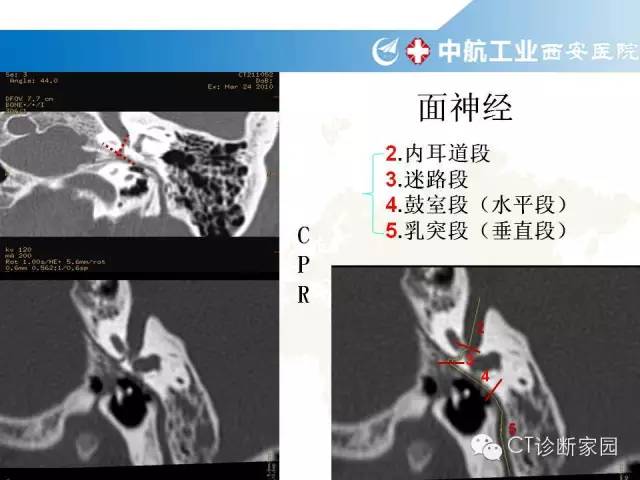 颞骨断层解剖及病例解读_蝶骨