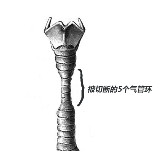 挣脱"魔鬼的手",高难度手术让花季女孩重获自由呼吸_气管