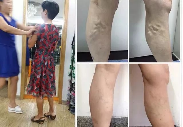 腿上青筋暴起在生姜里加了点它在腿上一刮青筋消失从此不再胀痛