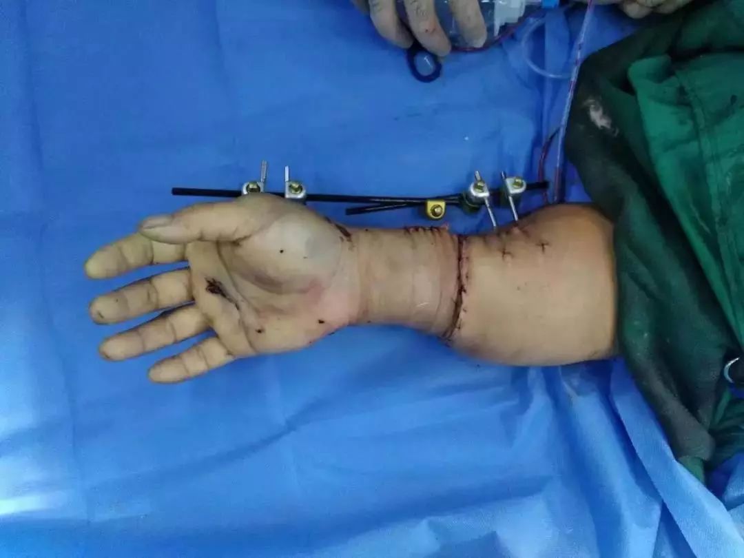 奇迹象山一男子断臂12小时失而复得画面不敢看