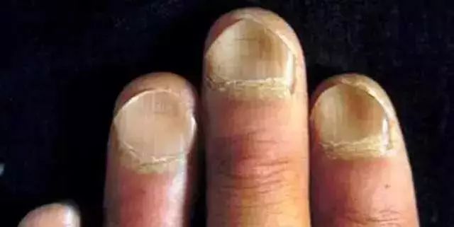 指甲上的月牙竖纹白点代表什么这8种指甲问题看看