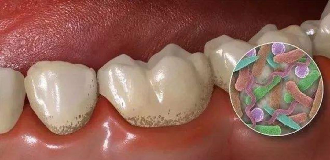 想要一口好牙,得学会这几种正确的清洁方法!_菌斑