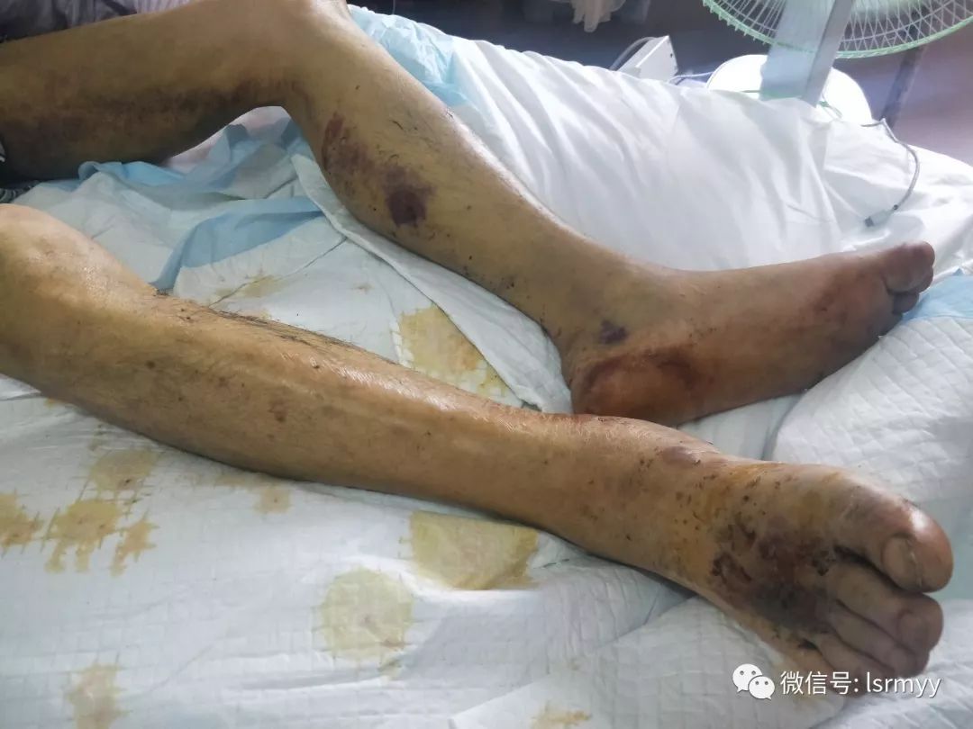 桑植一老农遭五步蛇连咬五口