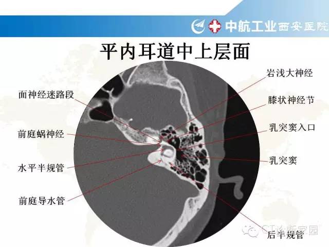 颞骨断层解剖及病例解读_蝶骨