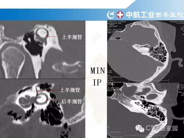 颞骨断层解剖及病例解读_蝶骨