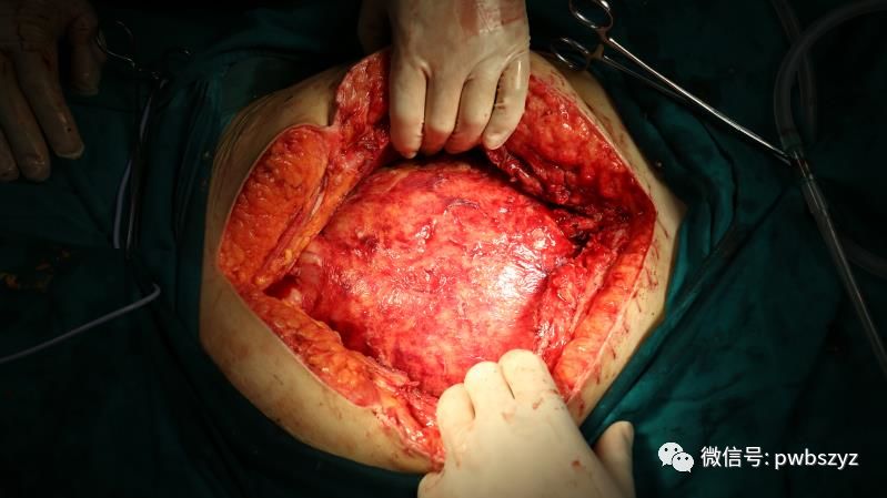 巨型肠梗阻切除术图片图片