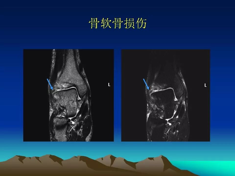 脚踝韧带核磁共振图片图片