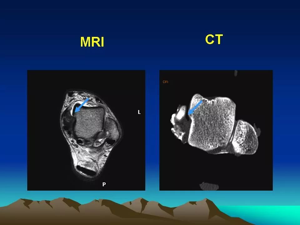 跟腱断裂mri图片
