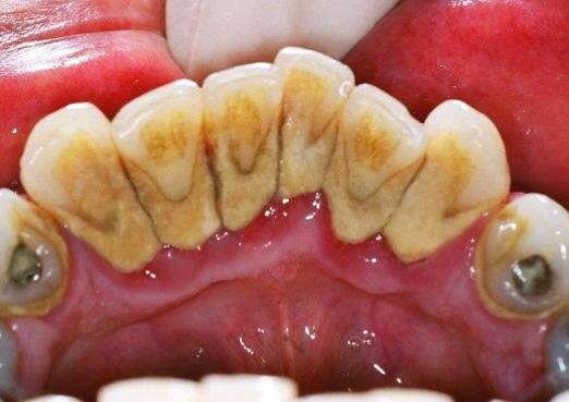 牙结石是什么 怎么去除牙结石?