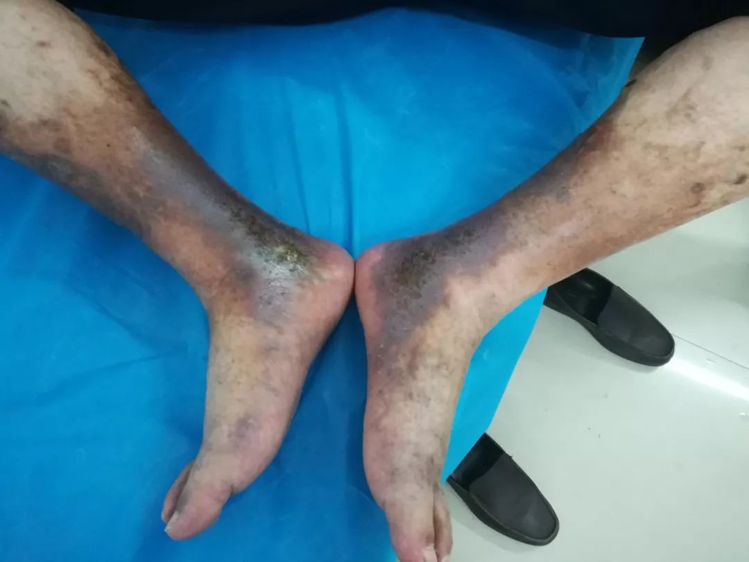 治疗下肢静脉曲张,该保守还是手术?