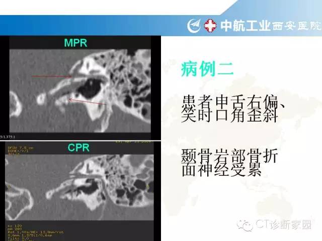 颞骨断层解剖及病例解读_蝶骨