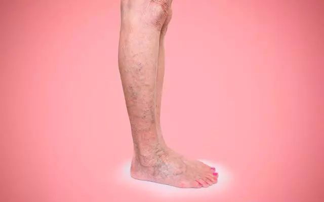 腿部发痒是静脉曲张在向你招手做好这几件事别因它造成截肢