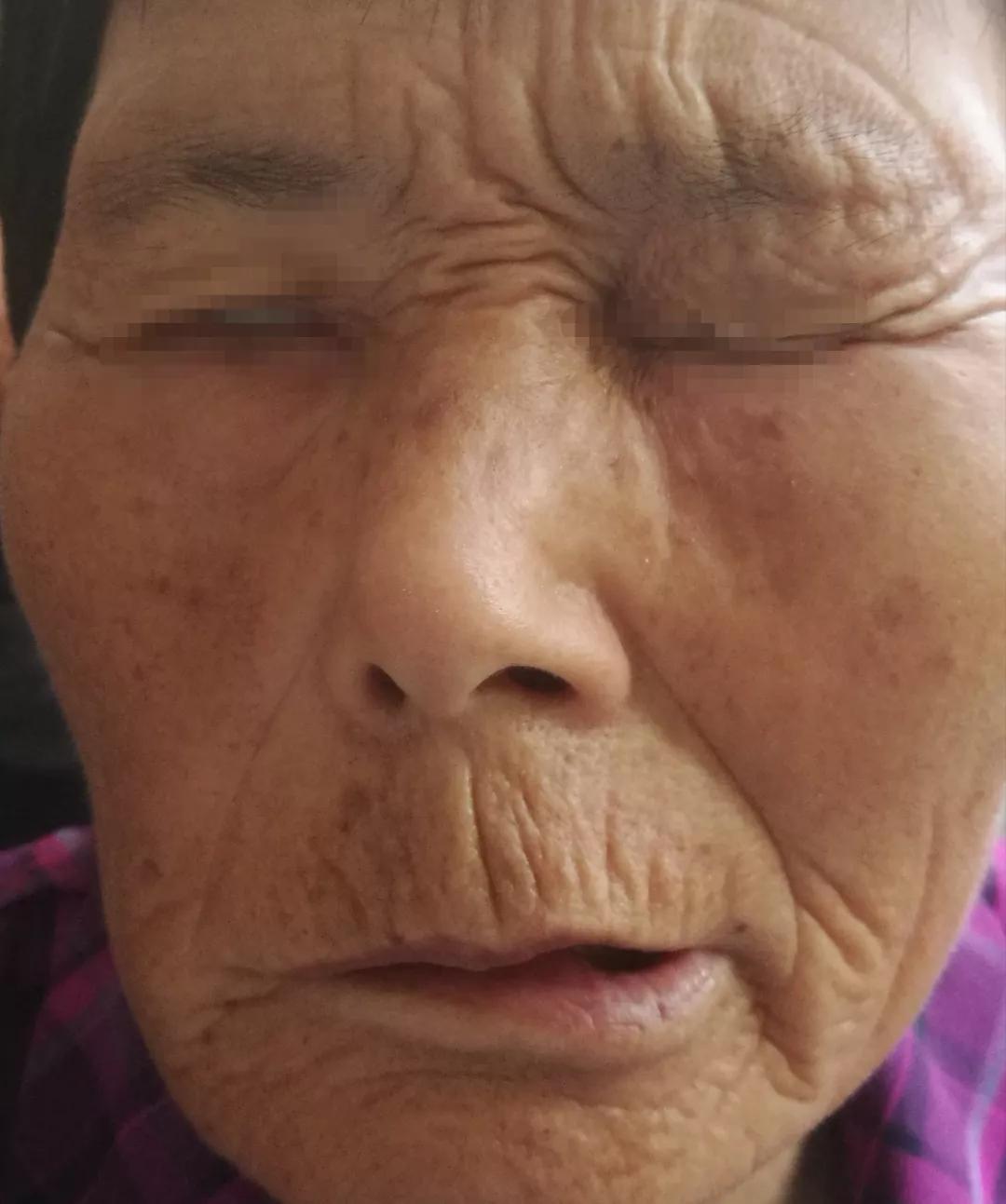 疱疹最快的治疗方法?