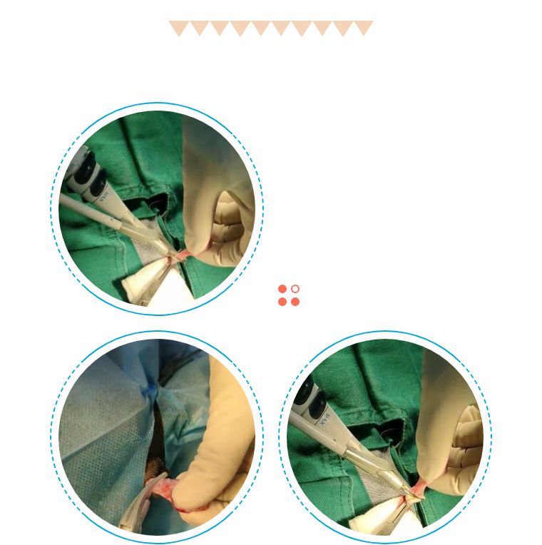 "拆蛋专家"的全新装备,流血少,恢复快,安全放心的——超声刀～_手术