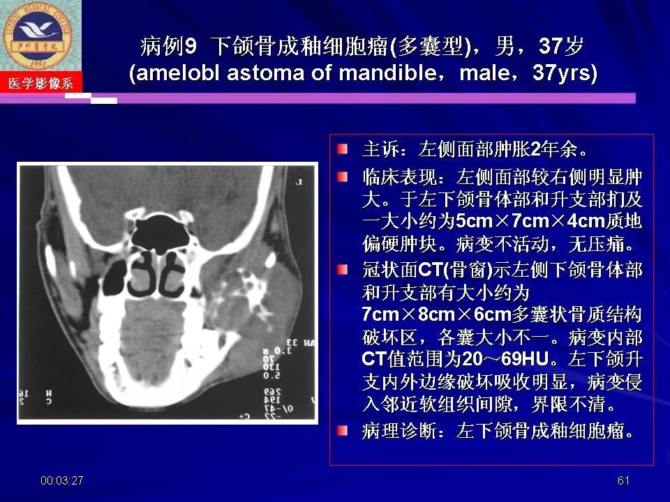 口腔颌面部囊肿肿瘤和肿瘤样病变的影像诊断丨影像天地