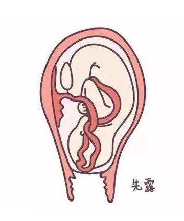 腹中胎儿快窒息了,浙江产妇竟拒绝手术!原因惊呆.