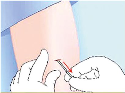 左炔诺孕酮皮下埋植避孕操作步骤