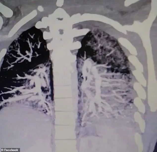 吸电子烟的肺图片