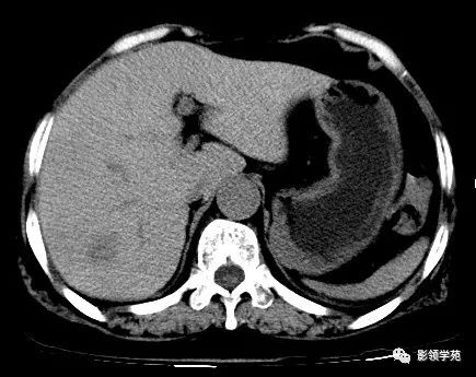 肝海绵状血管瘤ct图片