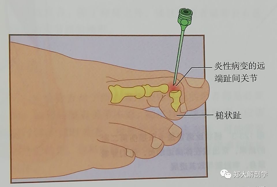 87趾囊肿是指在第一跖趾关节处的软组织肿胀,同时伴有第一跖趾关节