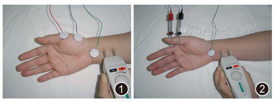 临床神经电生理在肌萎缩侧索硬化中的应用_传导