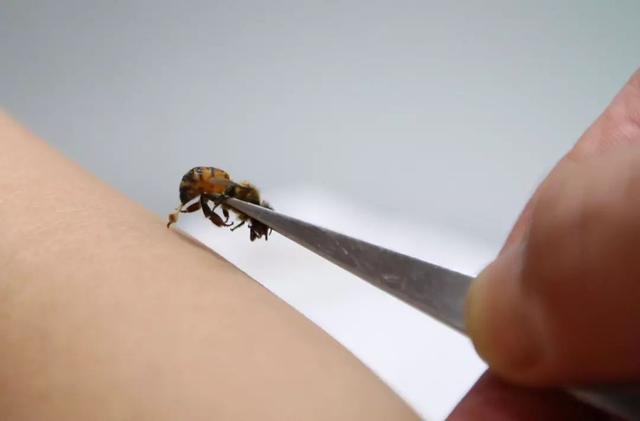 如果蜂刺留在伤口内(在红肿中心有一黑色小点),有时局部可引起化脓.