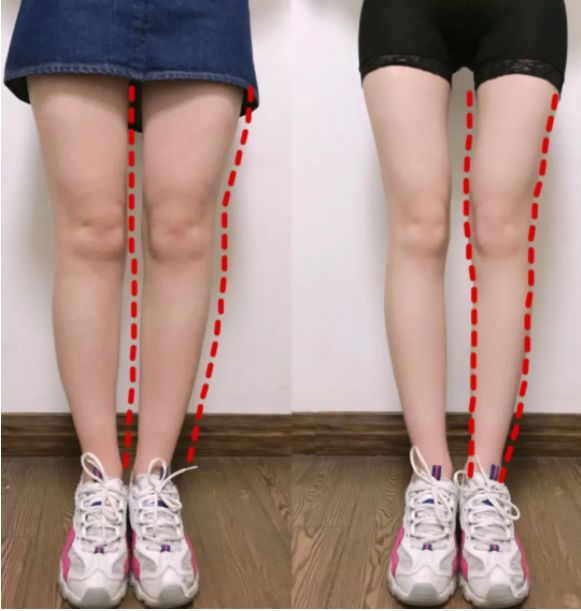 你瘦腿总是不成功是因为没碰见这位腿部整容大师