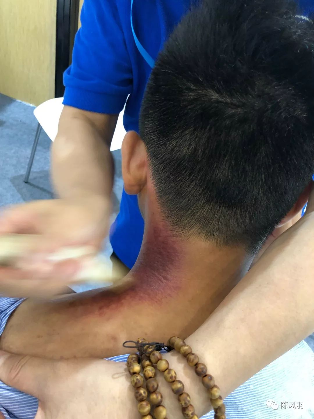 刮痧并非愈痛愈有效也不是刮得又黑又紫才好