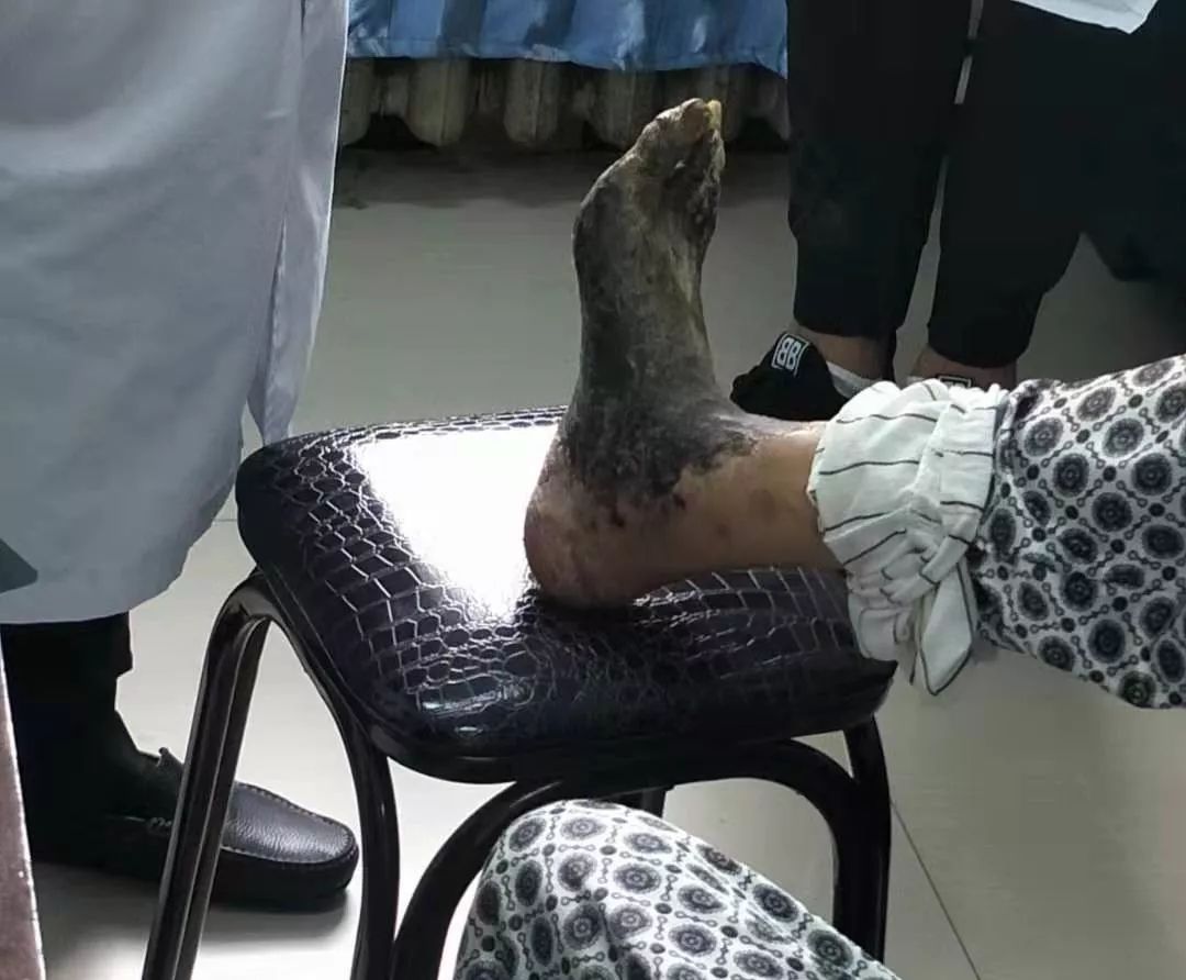 36岁男子患脉管炎双腿截肢妻离子散医生感叹来的太晚了