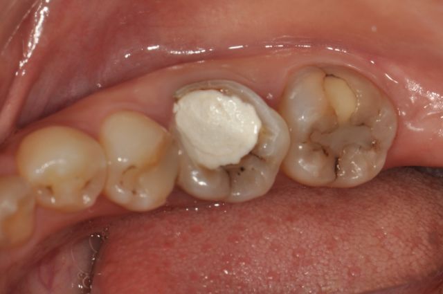 案例二:前牙发黑传统修复需磨牙做冠,即刻嵌体修复不伤牙体修复如新!