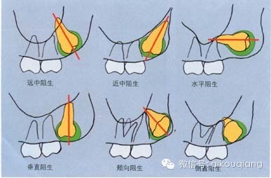 口腔麻醉拔牙術阻生牙拔除