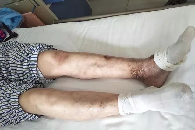 36岁男子患脉管炎双腿截肢妻离子散医生感叹来的太晚了