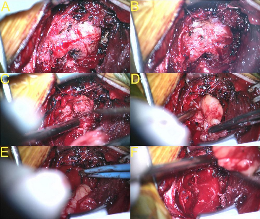 經頸前外側入路切除頸4/5啞鈴狀神經鞘瘤一例(脊柱脊髓系列十二)