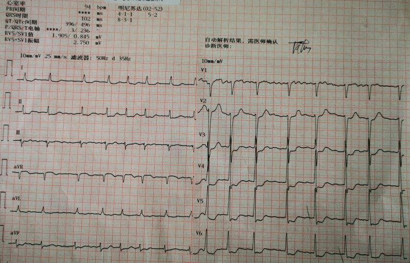 慢性心衰心电图表现图片