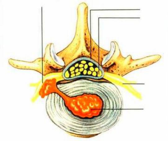 极外侧突出后正中突出2,按突出方向分型1,按突出程度分型膨隆型,突出