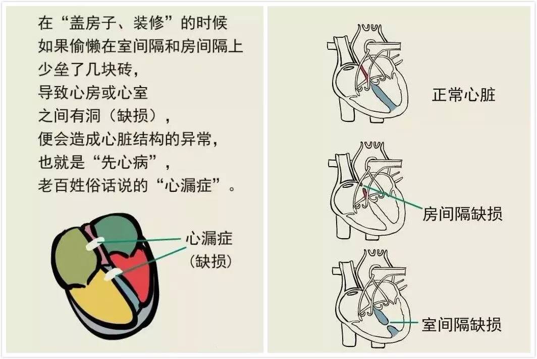 肺动脉闭锁,大动脉转位,完全型肺静脉异位引流,完全型心内膜垫缺损,主