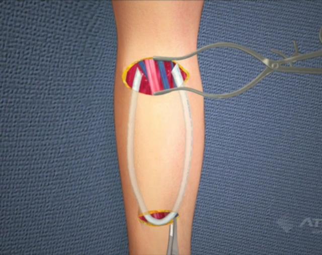 q人工血管移植内瘘手术需要全身麻醉吗?