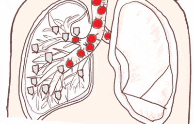 和她一样的人,全国还有500万…_肺动脉